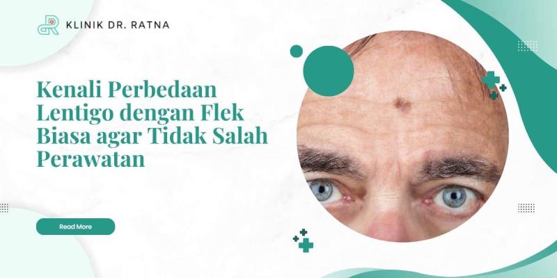 Kenali Perbedaan Lentigo dengan Flek Biasa agar Tidak Salah Perawatan