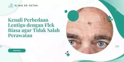 Kenali Perbedaan Lentigo dengan Flek Biasa agar Tidak Salah Perawatan