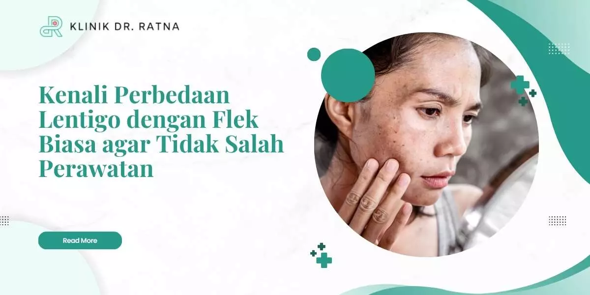 Kenali Perbedaan Lentigo dengan Flek Biasa agar Tidak Salah Perawatan