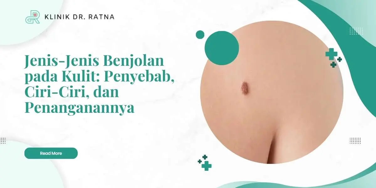 Jenis-Jenis Benjolan pada Kulit: Penyebab, Ciri-Ciri, dan Penanganannya Jenis-Jenis Benjolan pada Kulit: Penyebab, Ciri-Ciri, dan Penanganannya
