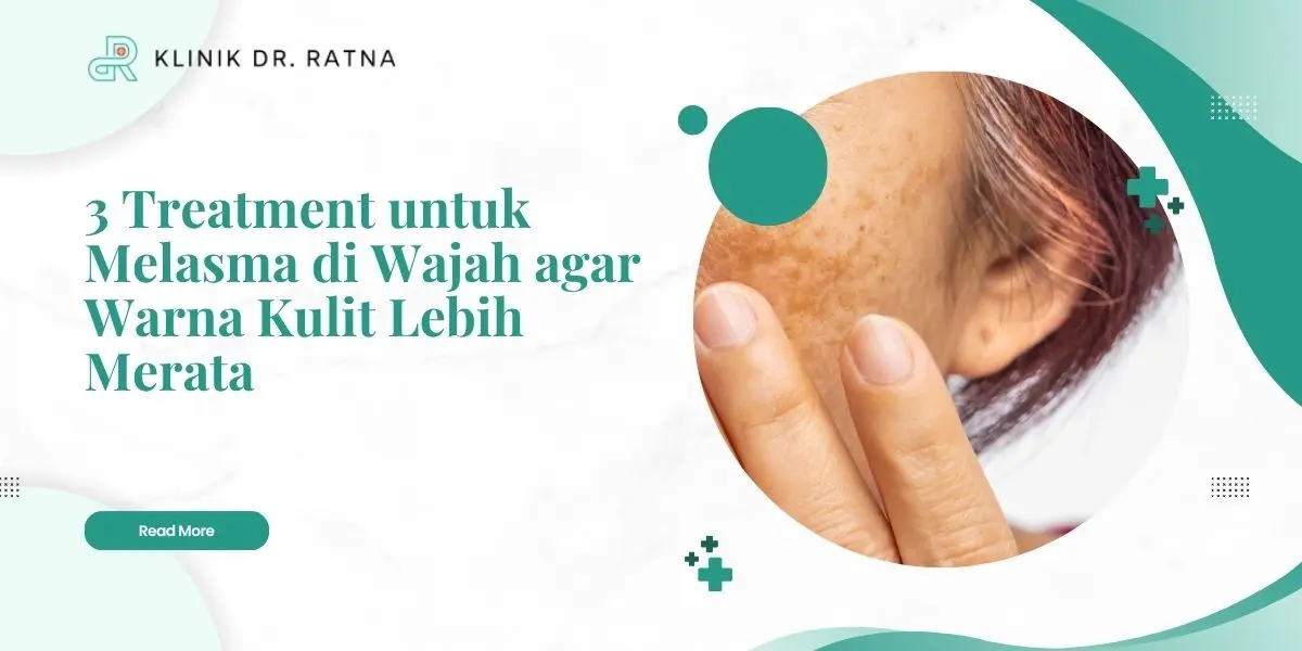 3 Treatment untuk Melasma di Wajah agar Warna Kulit Lebih Merata