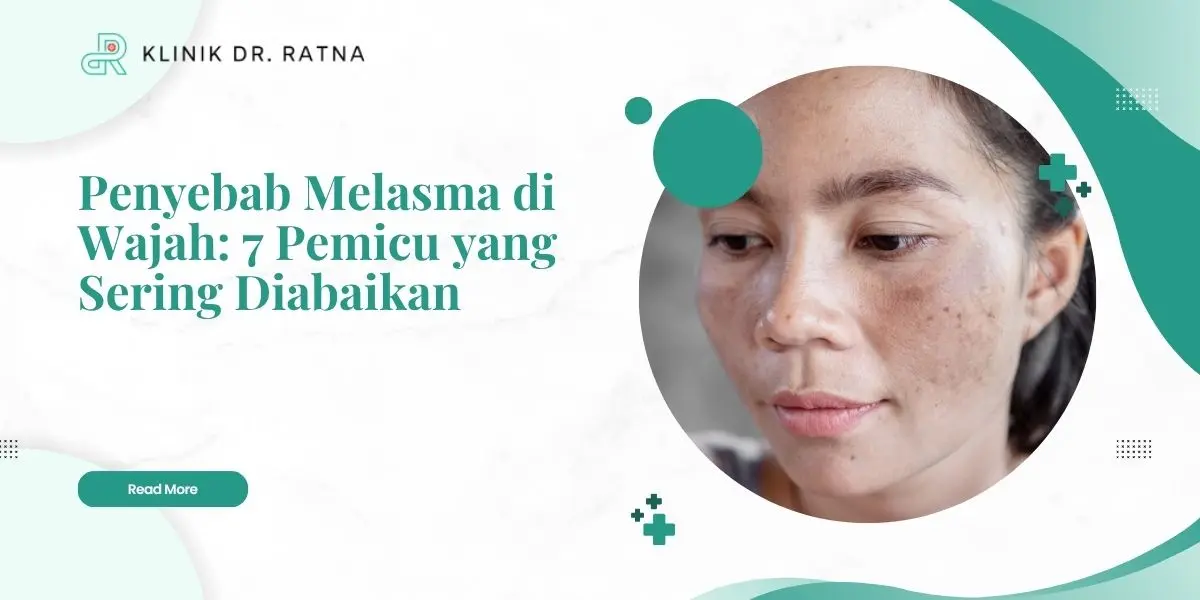 Penyebab Melasma di Wajah: 7 Pemicu yang Sering Diabaikan