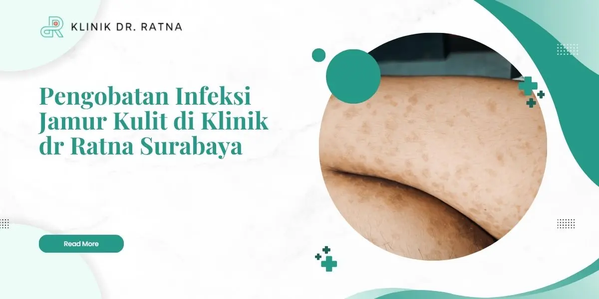 Pengobatan Infeksi Jamur Kulit di Klinik dr Ratna Surabaya