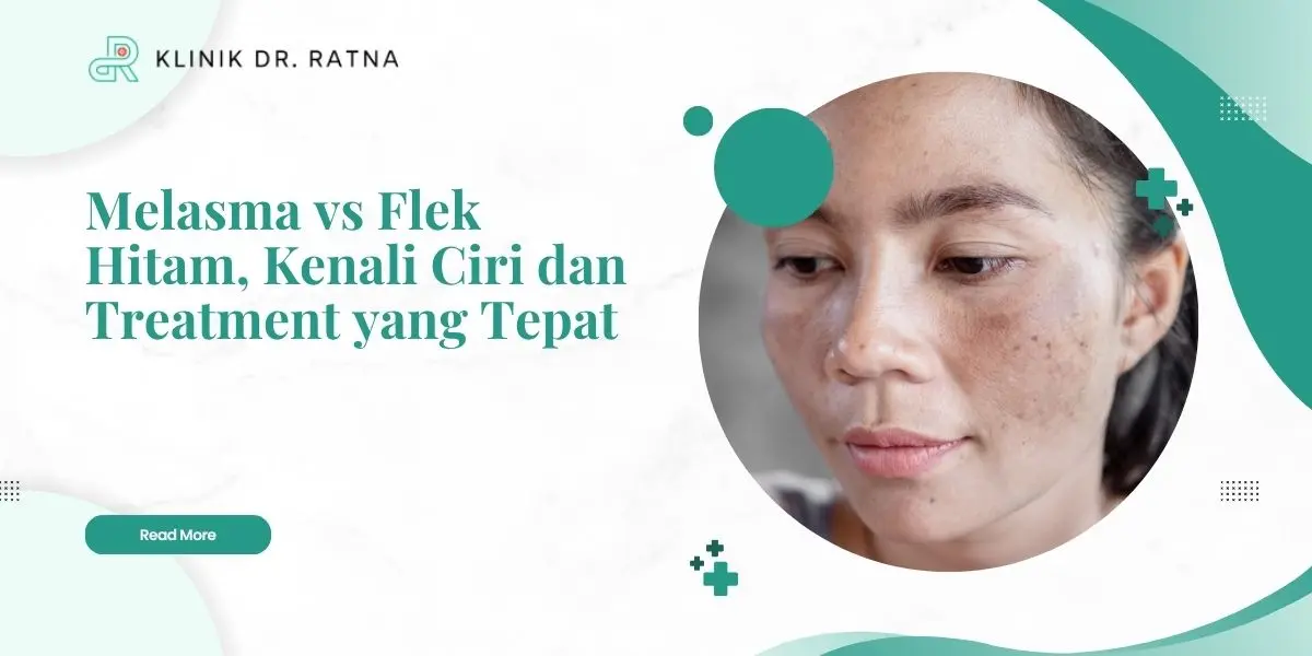 Melasma vs Flek Hitam, Kenali Ciri dan Treatment yang Tepat