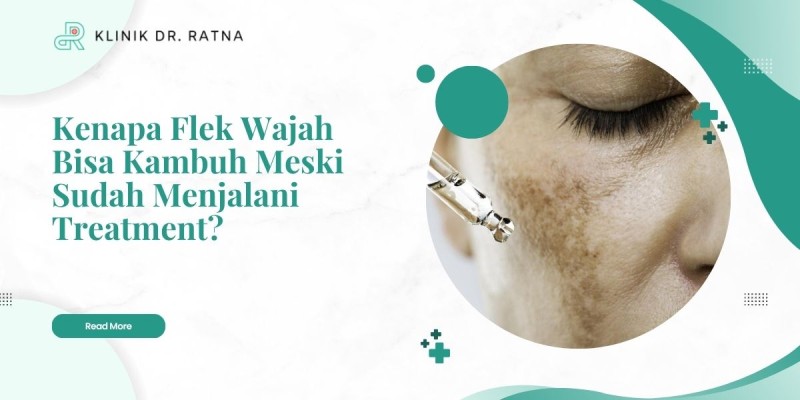 Kenapa Flek Wajah Bisa Kambuh Meski Sudah Menjalani Treatment?