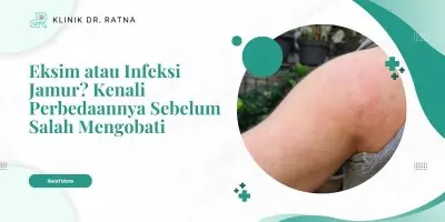 Eksim atau Infeksi Jamur? Kenali Perbedaannya Sebelum Salah Mengobati