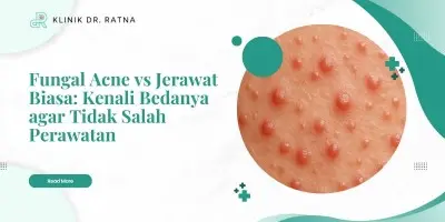 Fungal Acne vs Jerawat Biasa: Kenali Bedanya agar Tidak Salah Perawatan