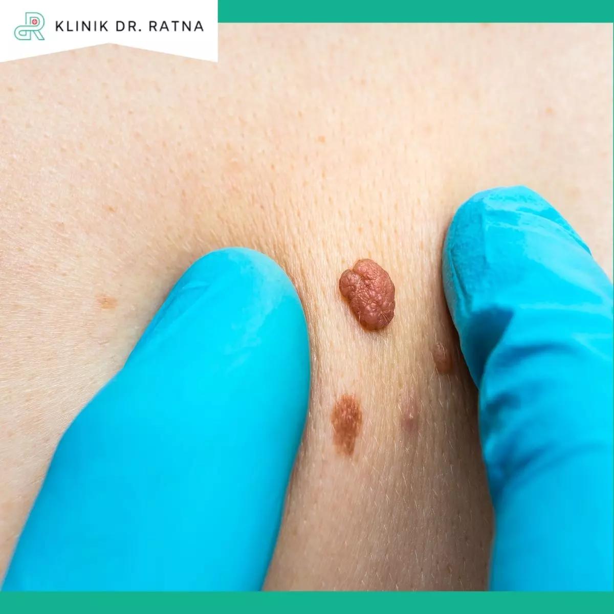 3. Skin Tag Removal
