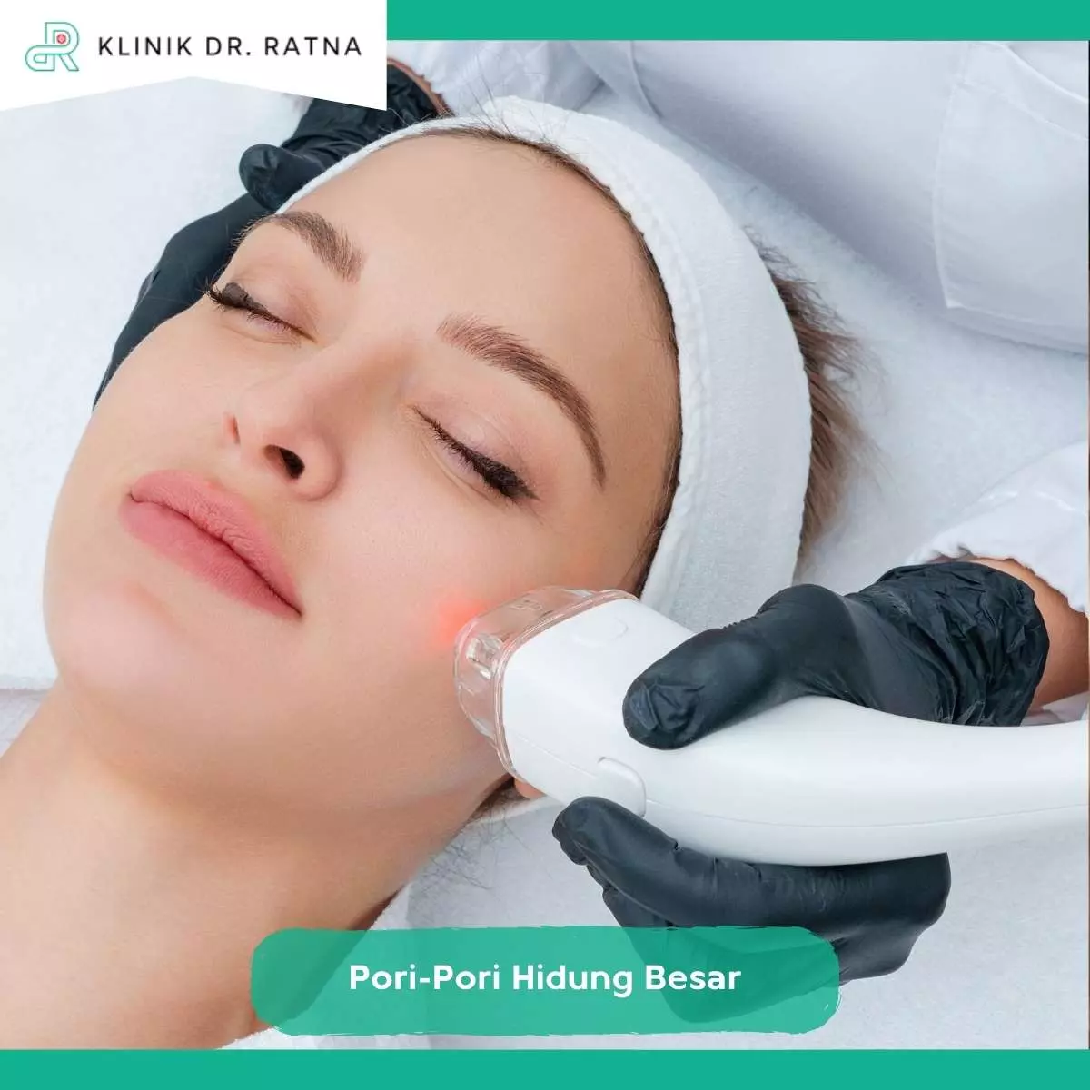 Treatment CO2 Laser untuk Memperkecil Pori-Pori Hidung