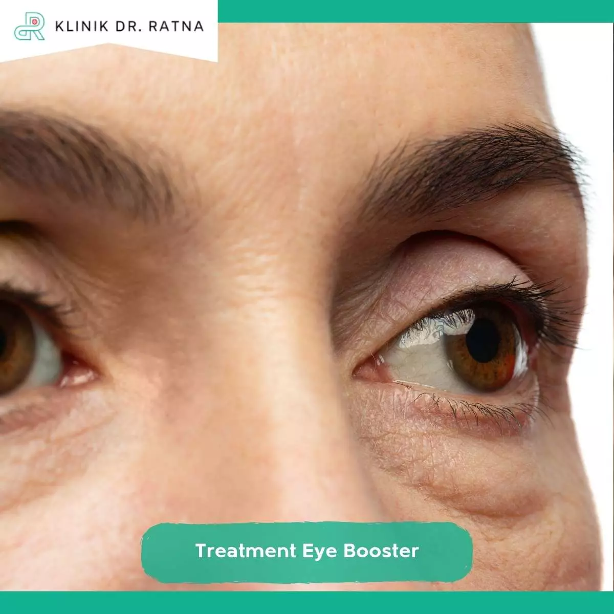Kelebihan Treatment Eye Booster di Klinik Dr Ratna Surabaya