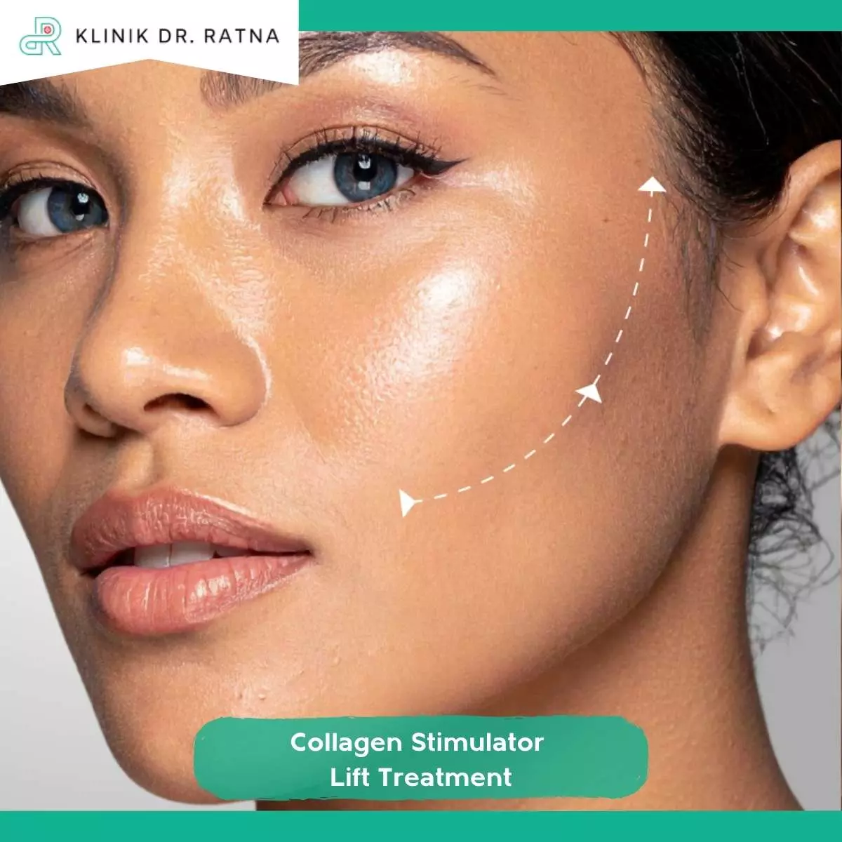 Bagaimana Collagen Stimulator Membantu Membentuk Wajah Lebih Simetris?