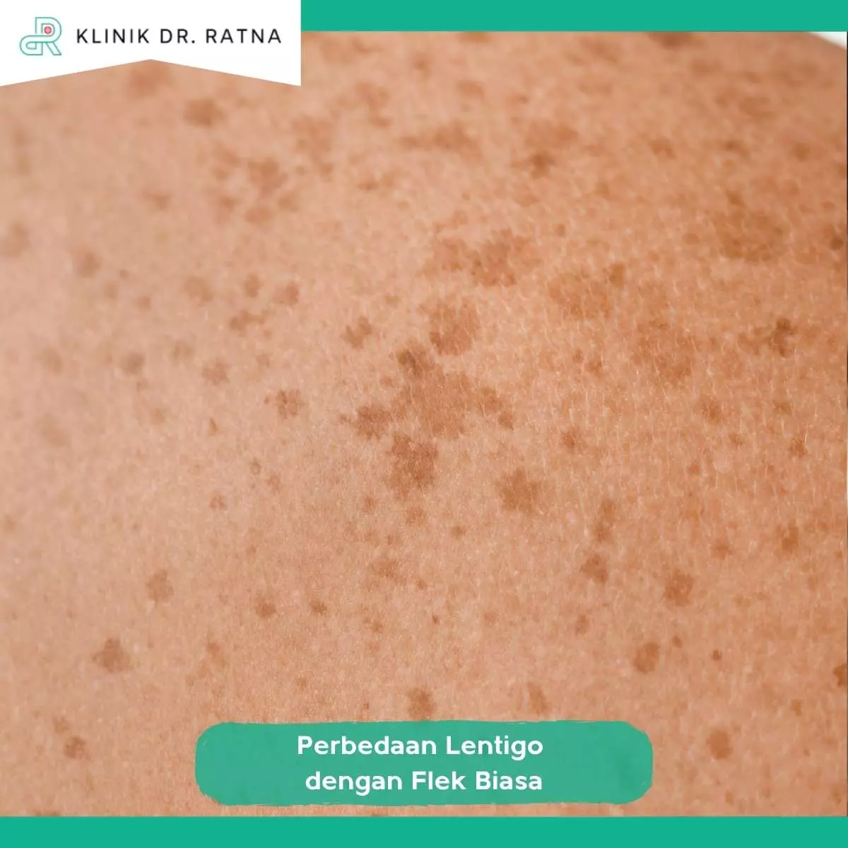 Tips Mencegah Lentigo dan Flek Hitam 