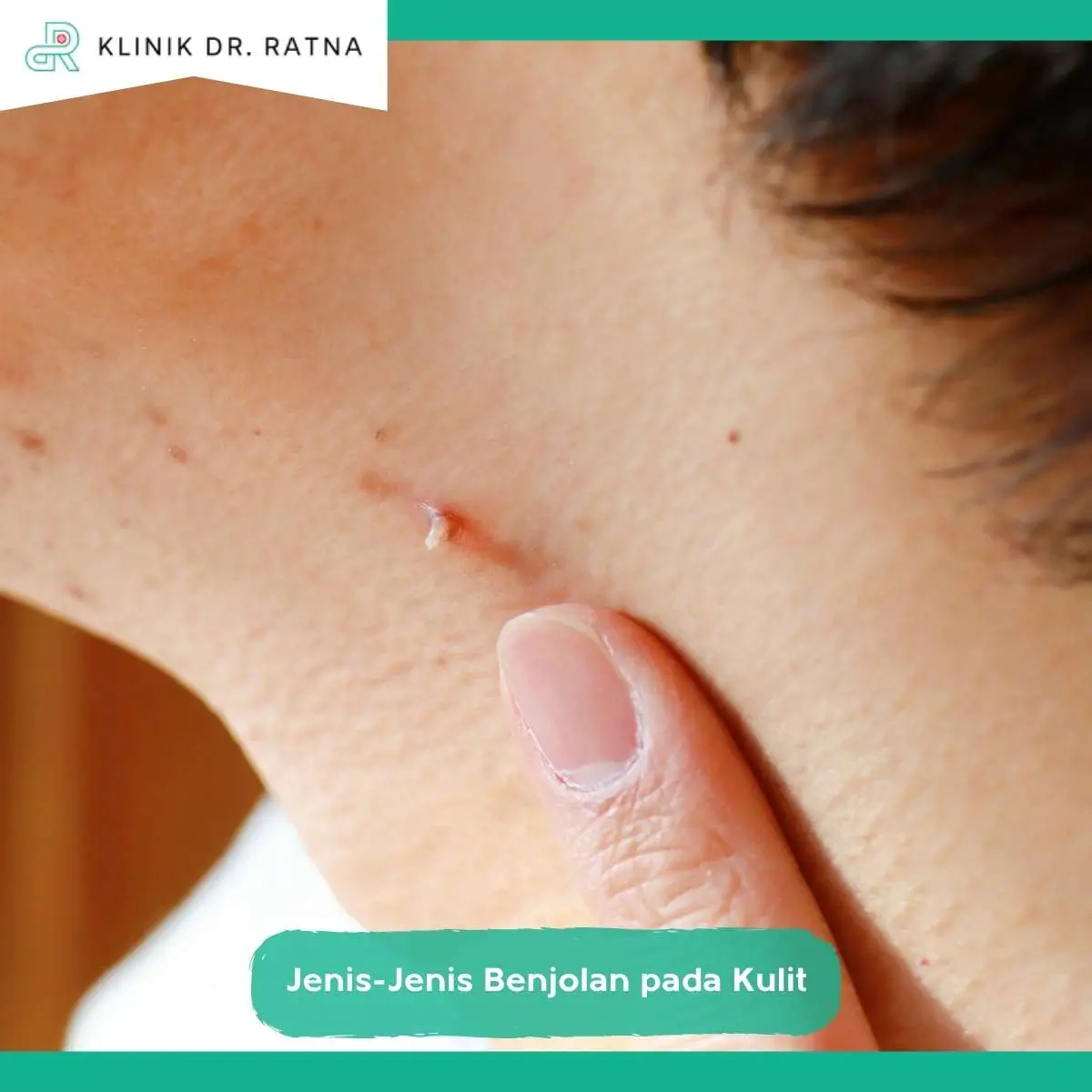 Mengapa Benjolan pada Kulit Tidak Boleh Diobati Sembarangan?