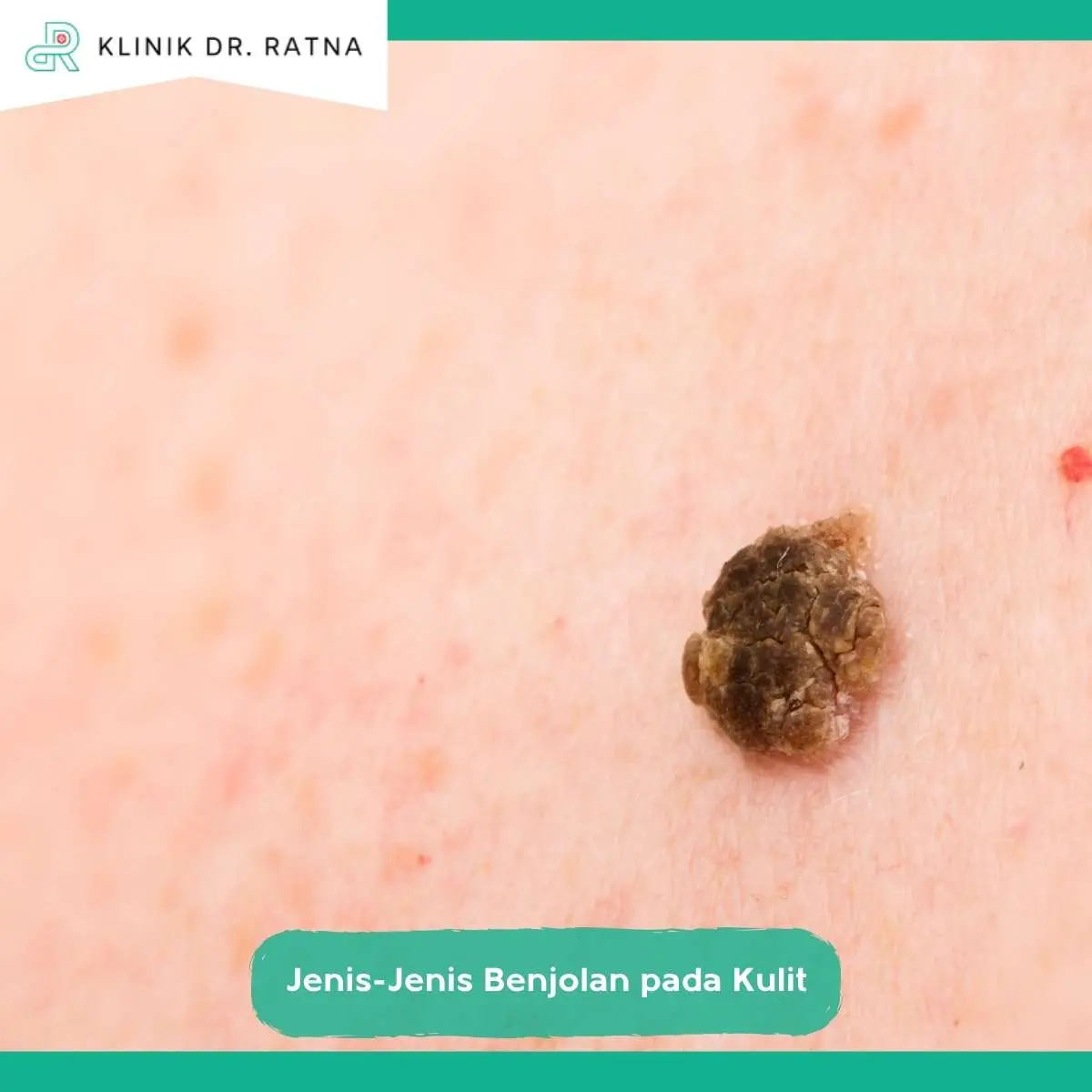Penanganan dan Pengobatan Benjolan pada Kulit