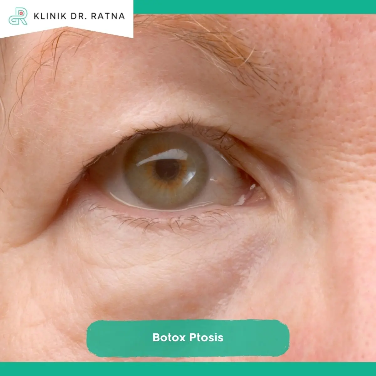 Kapan Ptosis Setelah Botox Biasanya Mulai Terlihat?