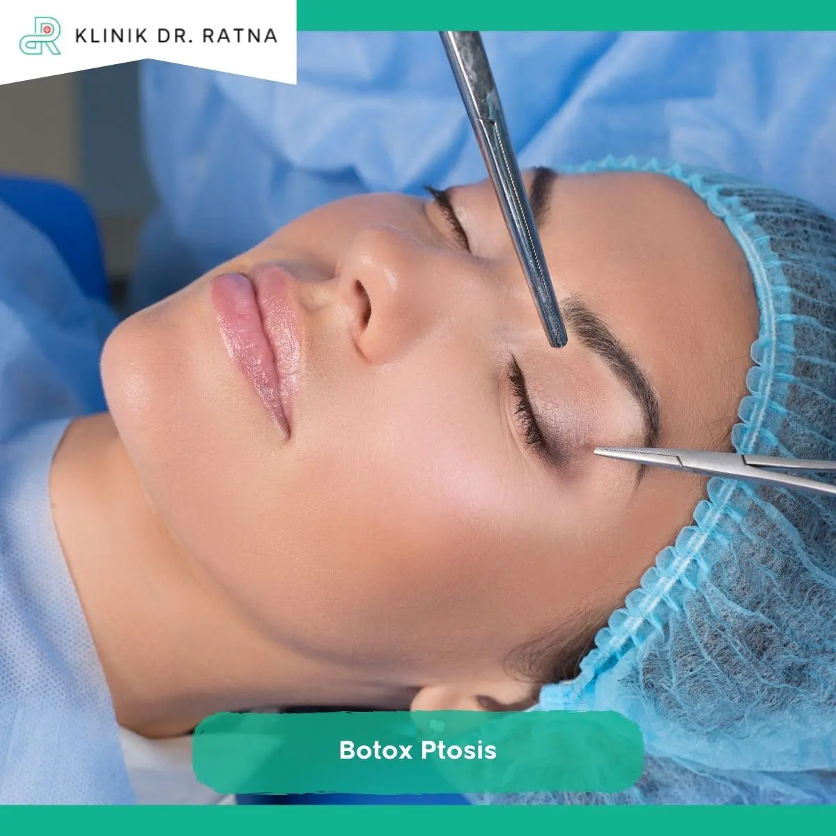 Bagaimana Cara Mengatasi Ptosis Setelah Botox?