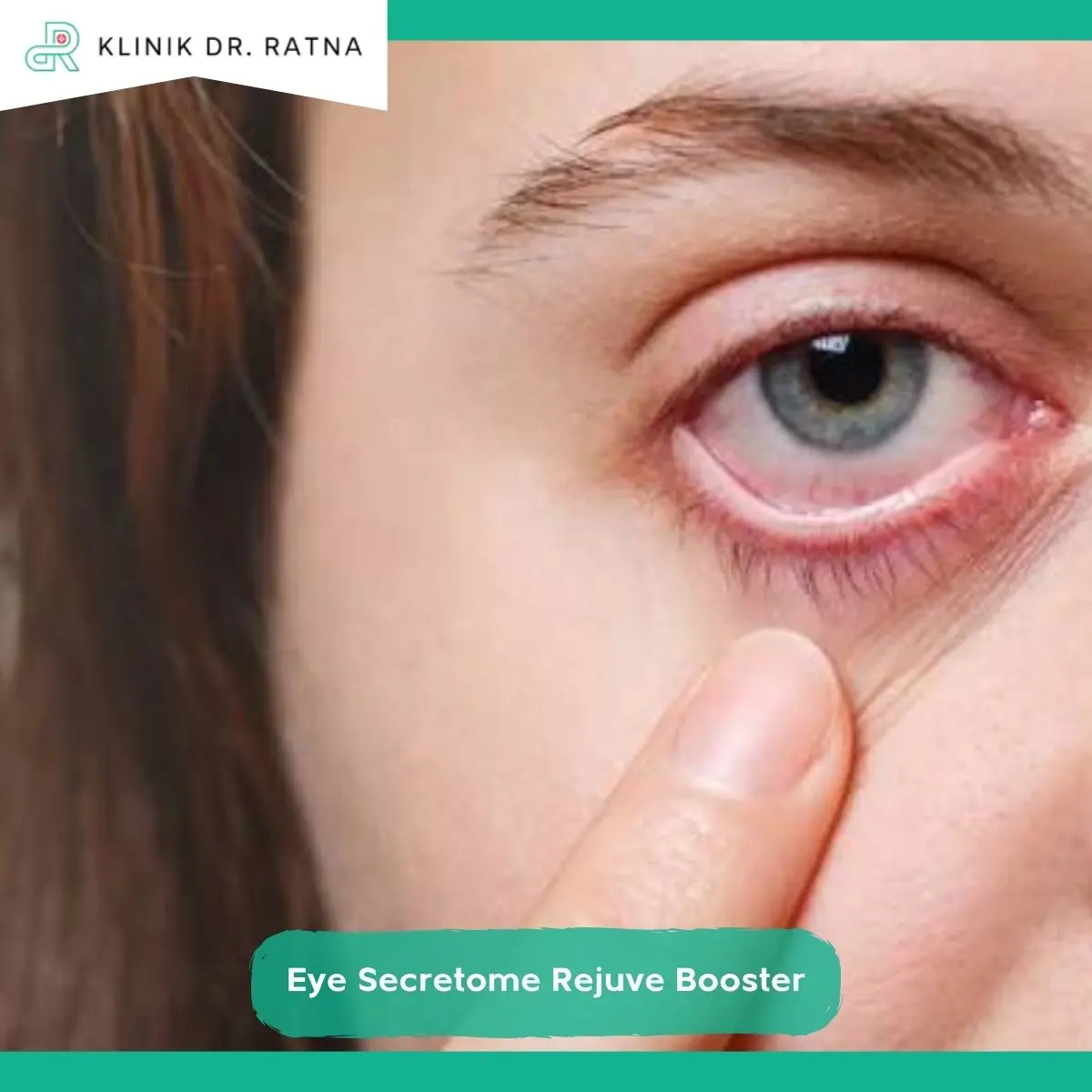 Mengapa Mata Panda dan Eye Bag Bisa Muncul?
