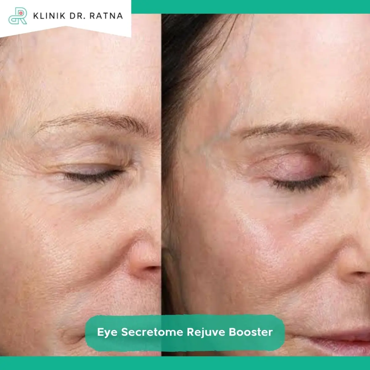 Apa Itu Eye Secretome Rejuve Booster?