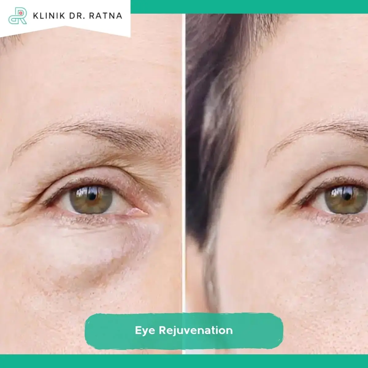 Apa Itu Eye Rejuvenation?
