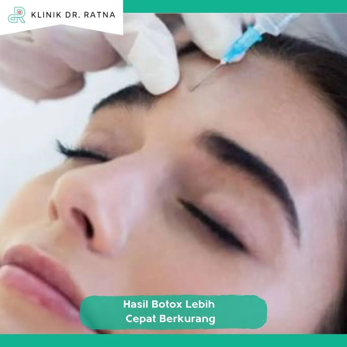 Berapa Lama Hasil Botox Biasanya Bertahan?