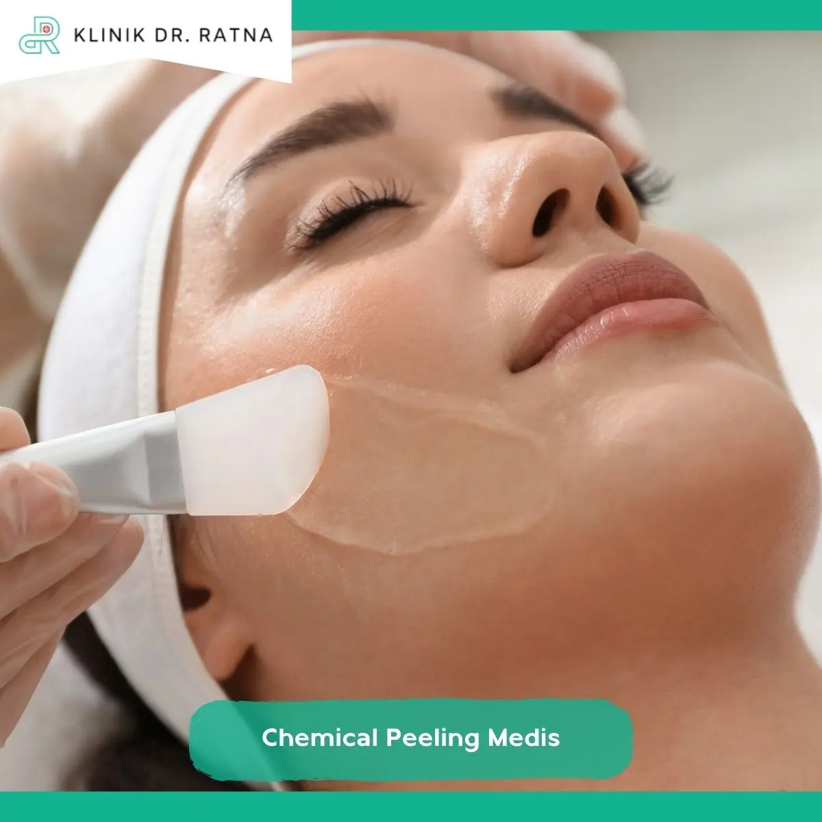 Apa Itu Chemical Peeling Medis?