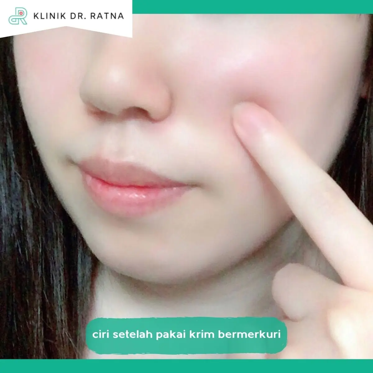 Apa Ciri-Ciri Kulit yang Perlu Diwaspadai?