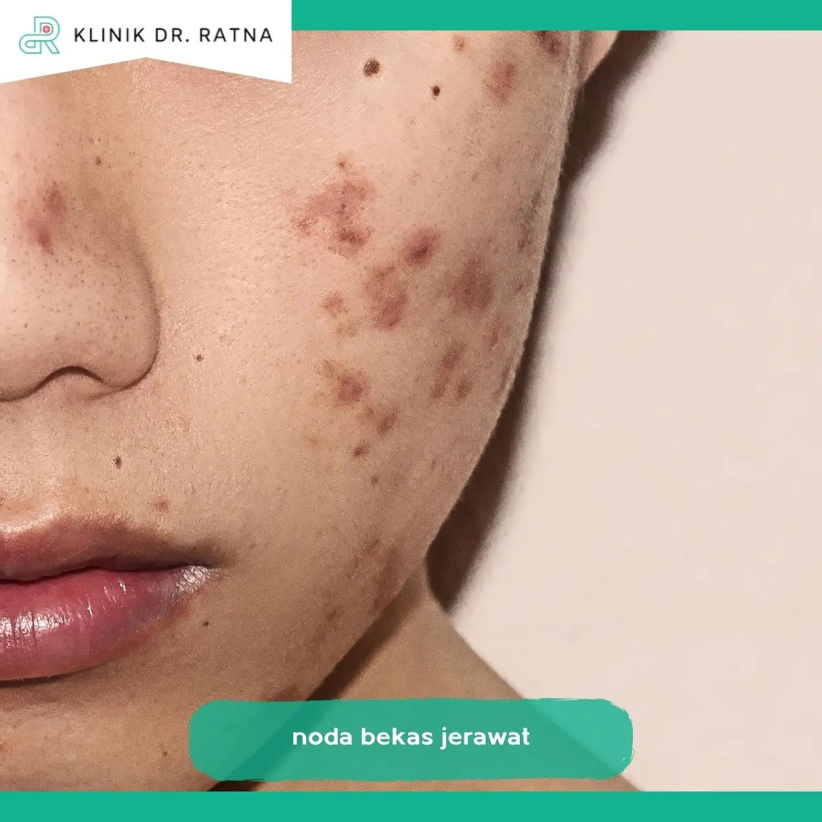 Noda Bekas Jerawat dan Bopeng Bukan Masalah yang Sama