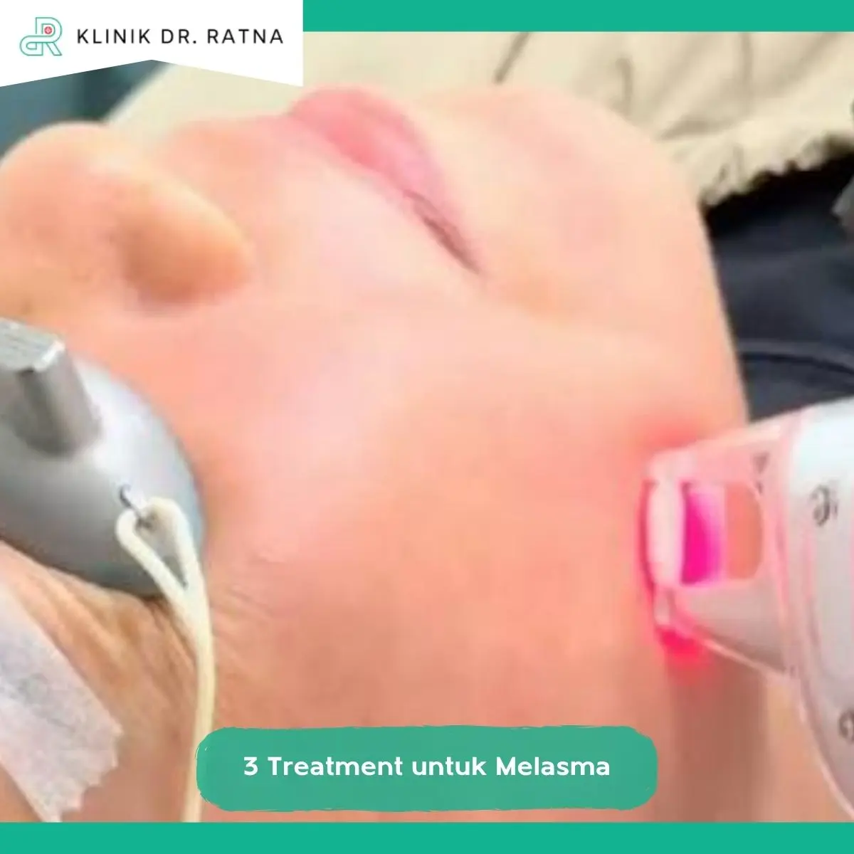 Mengapa Treatment Melasma Wajah Perlu Disesuaikan dengan Kondisi Kulit?