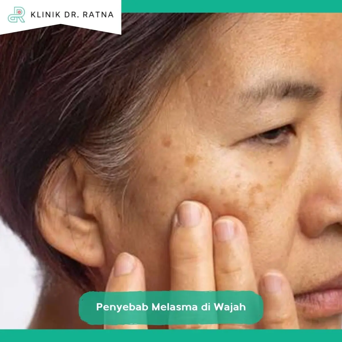 Apa Itu Melasma dan Bagaimana Ciri-Cirinya?