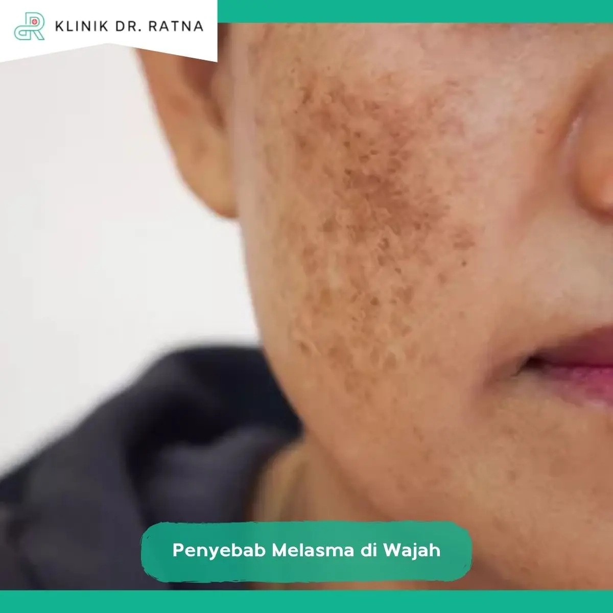 Penyebab Melasma di Wajah: 7 Pemicu yang Sering Diabaikan