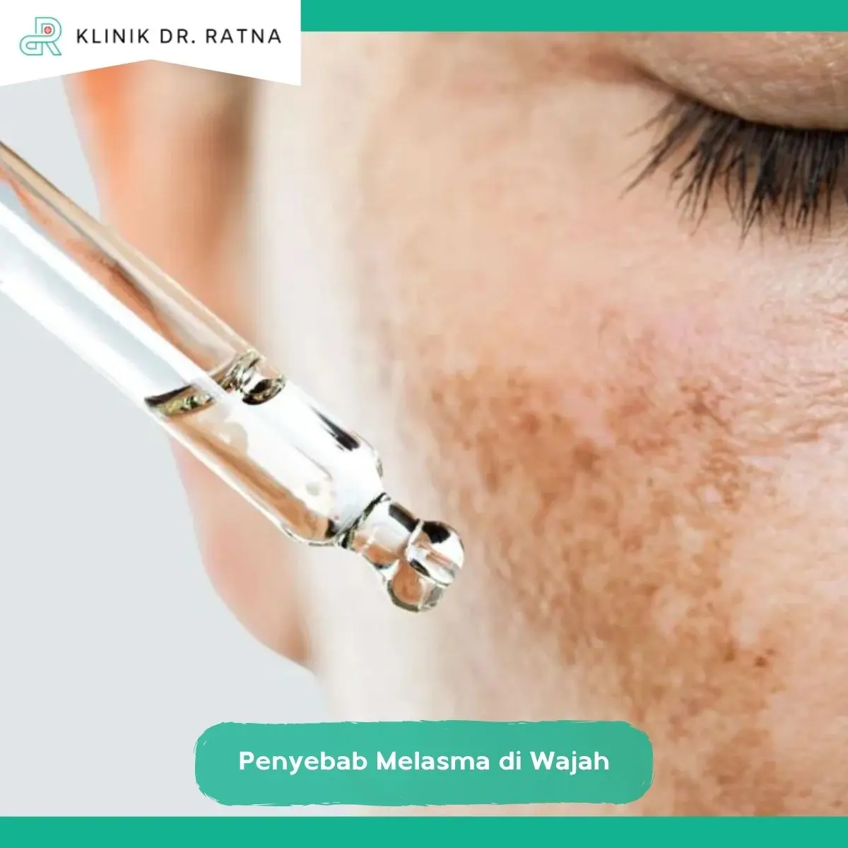 Pilihan Perawatan dan Pengobatan Melasma