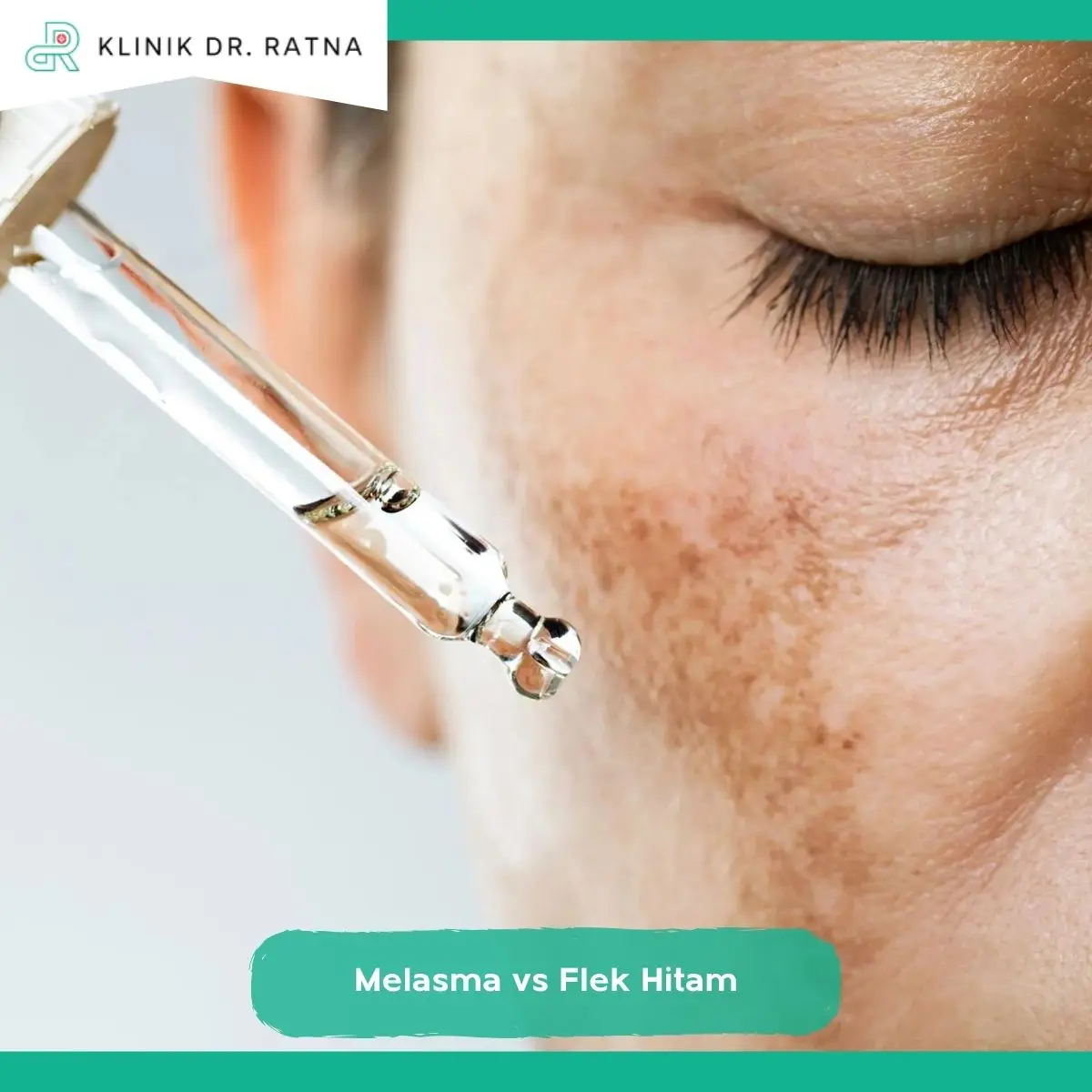 Apa Itu Melasma dan Flek Hitam?