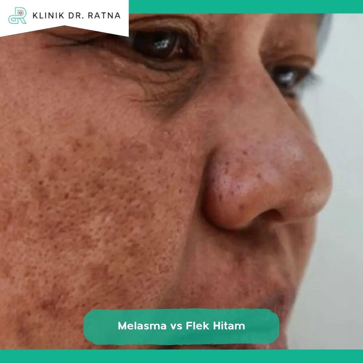 Perbedaan Penyebab Melasma dan Flek Hitam yang Perlu Dikenali