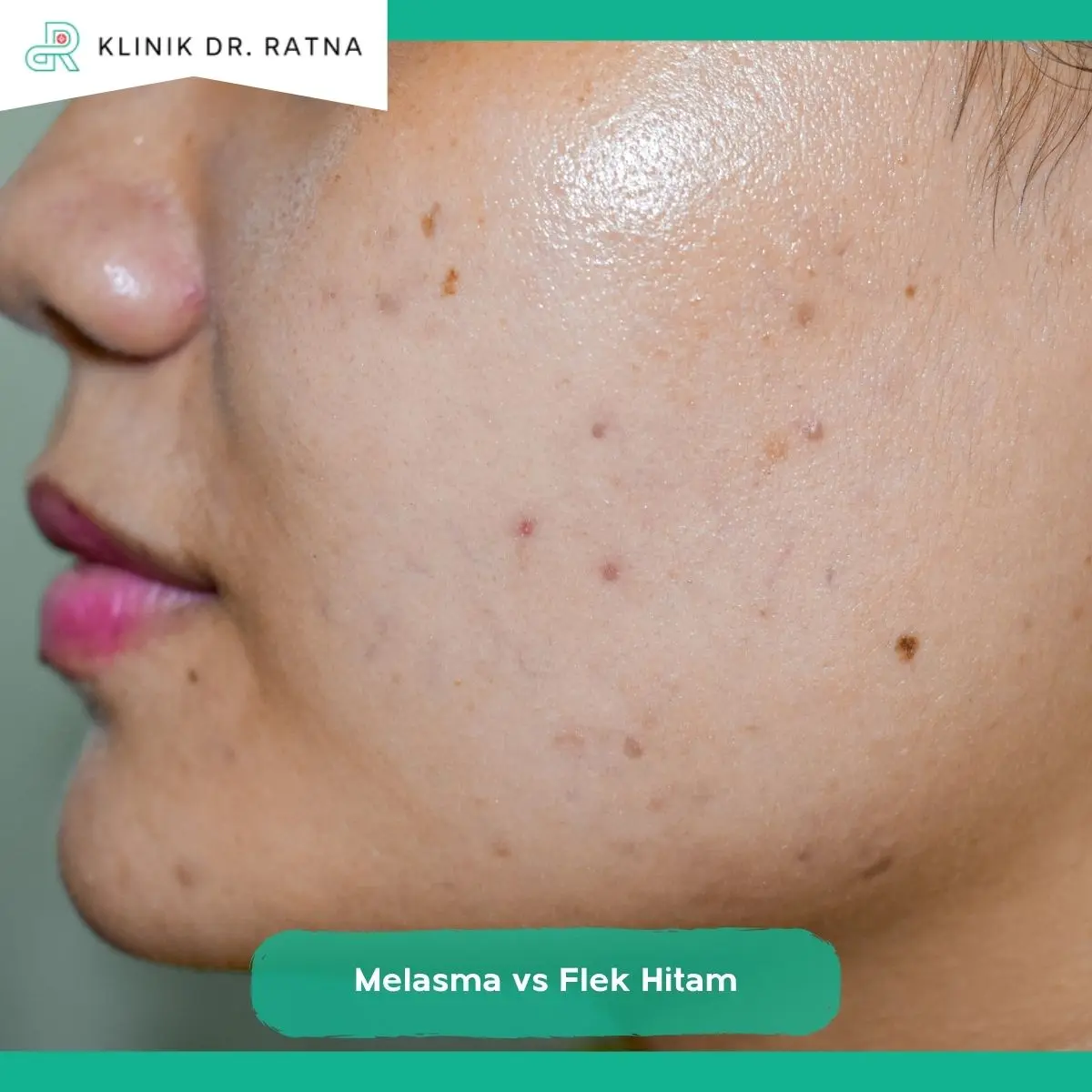 Treatment Melasma dan Flek Hitam, Apakah Sama?