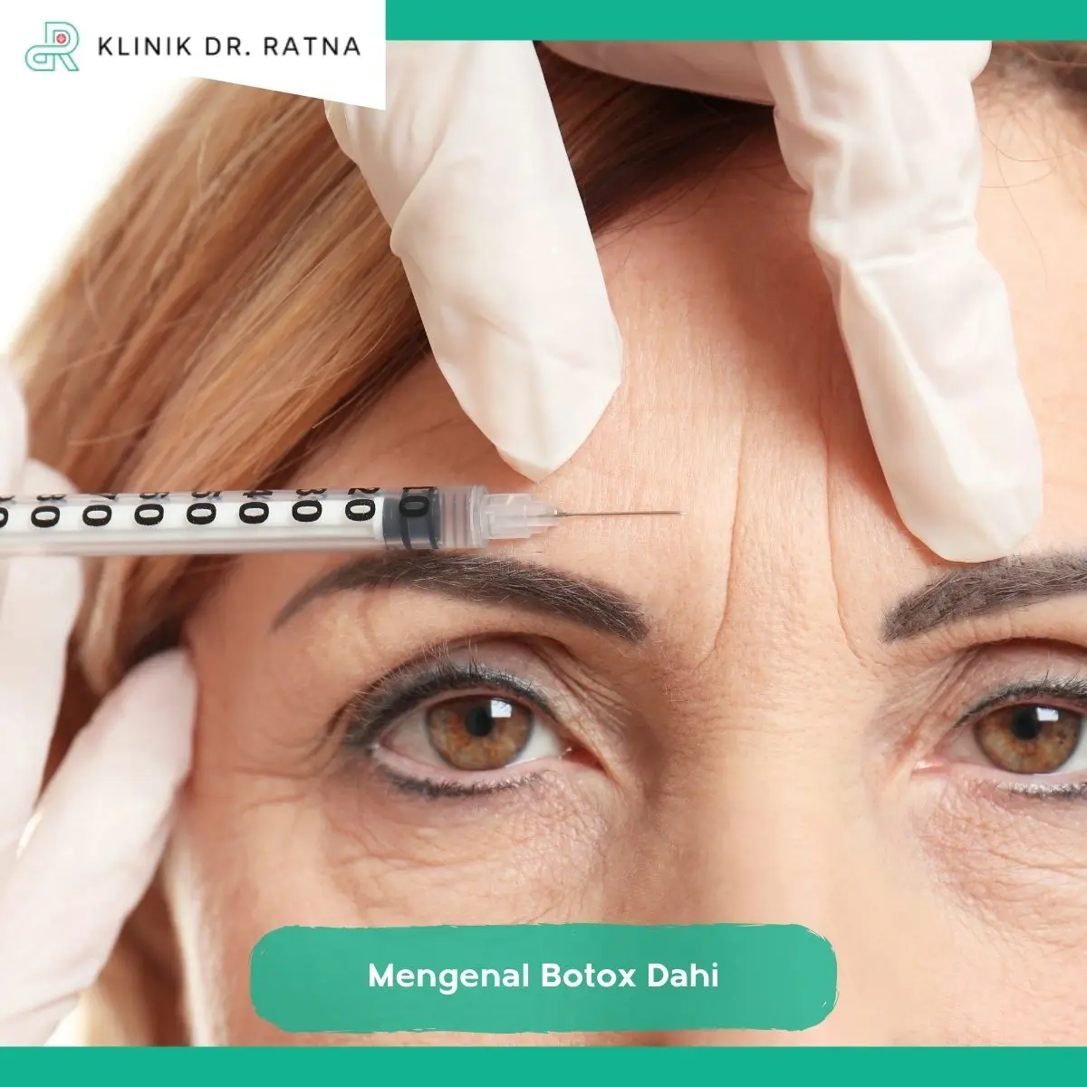Berapa Lama Botox Dahi Bertahan?