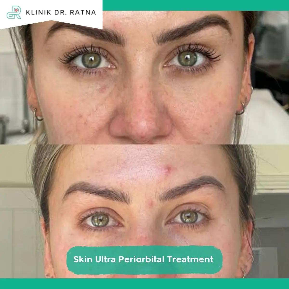 Mengenal Skin Ultra Periorbital Treatment dan Cara Kerjanya