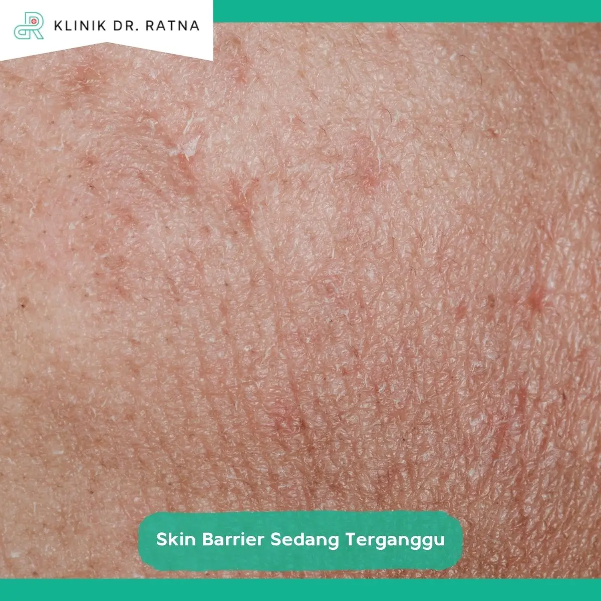 Kulit Perih dan Sensitif Bisa Menjadi Tanda Skin Barrier Rusak