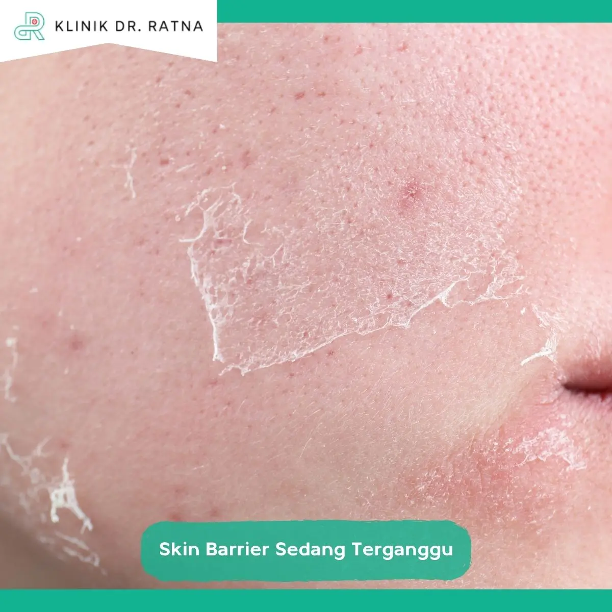 Cara Memperbaiki Skin Barrier yang Rusak