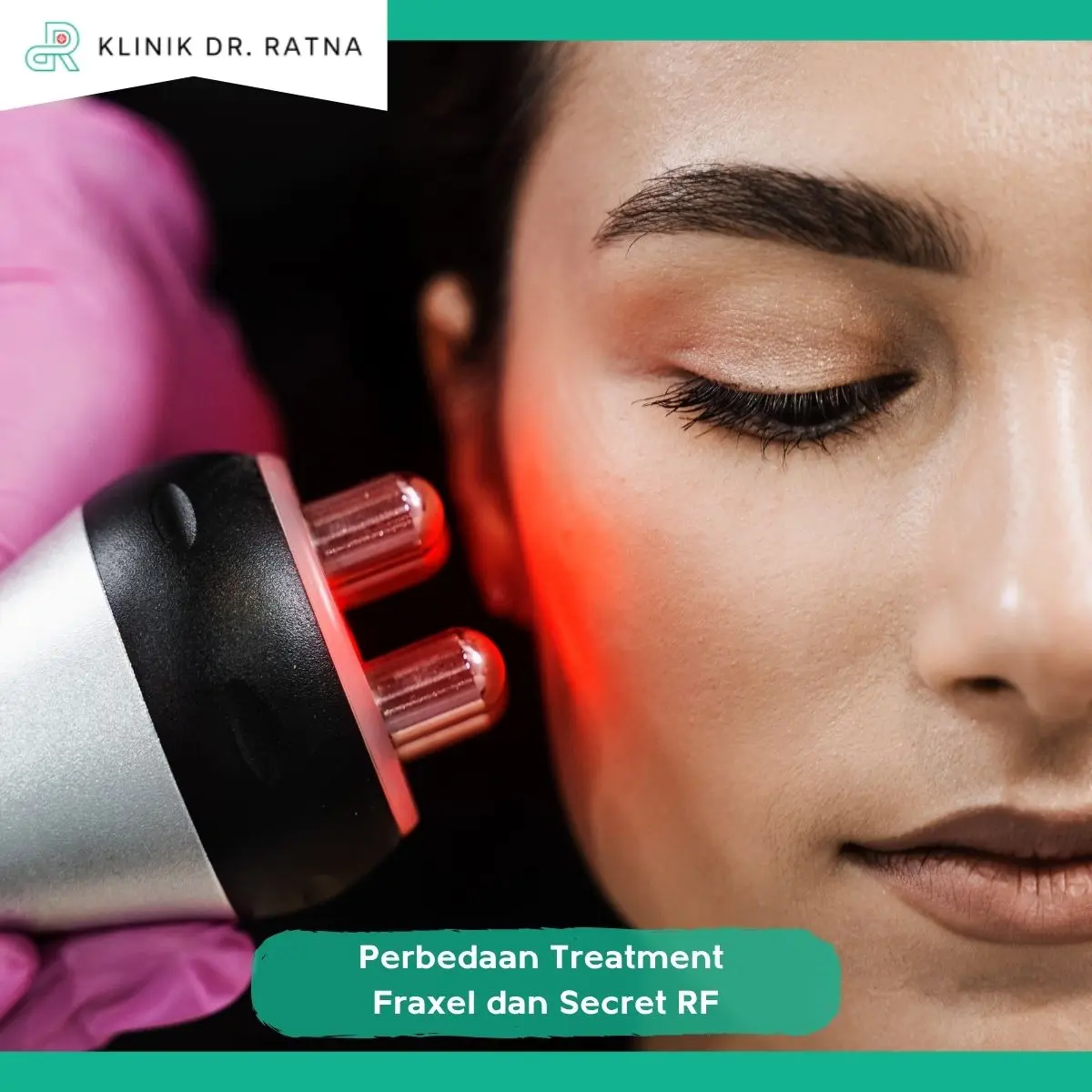 Manfaat Treatment Fraxel dan Secret RF