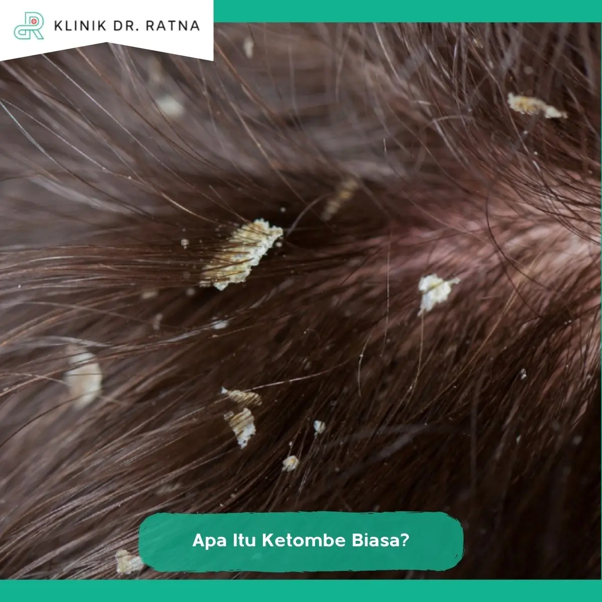 Apa Itu Ketombe Biasa?