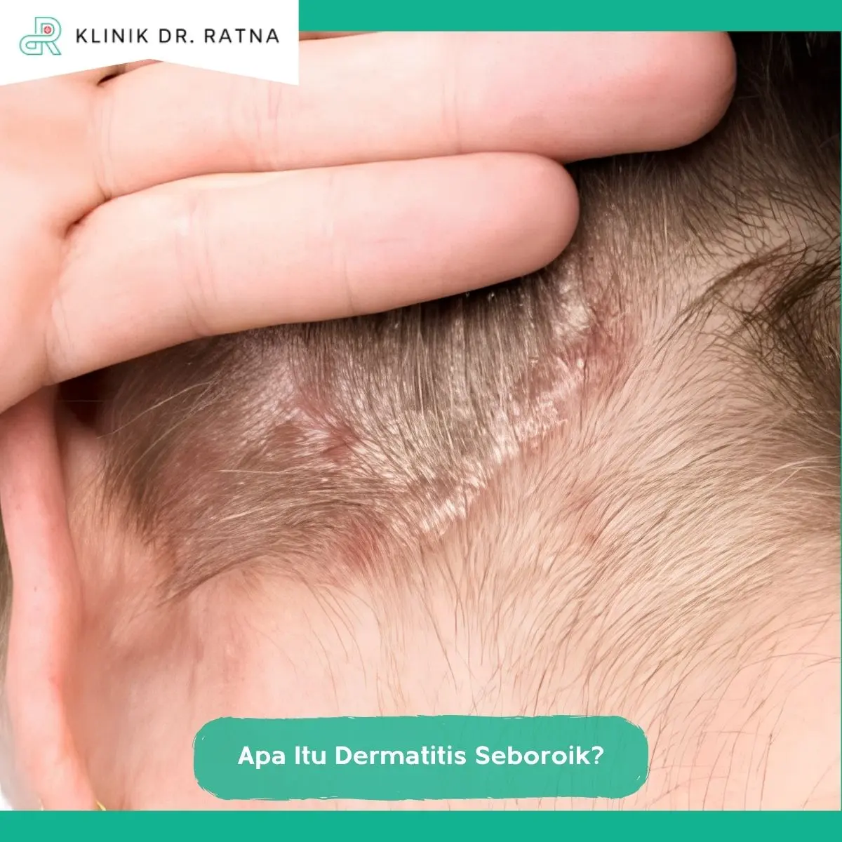 Apa Itu Dermatitis Seboroik?