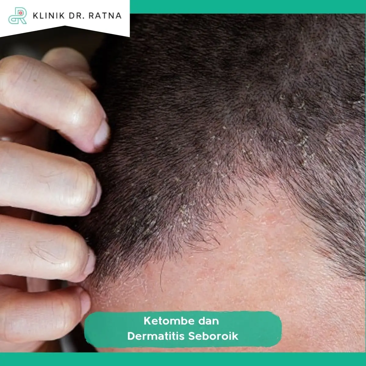 Apakah Ketombe dan Dermatitis Seboroik Menyebabkan Rambut Rontok?