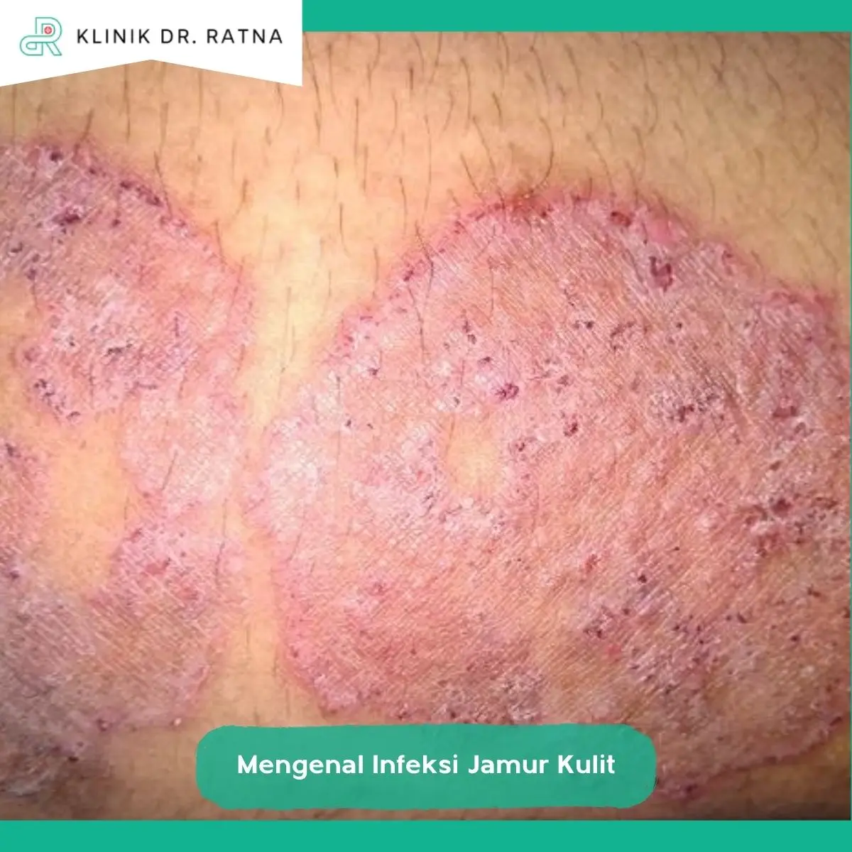 Apa Itu Infeksi Jamur pada Kulit?