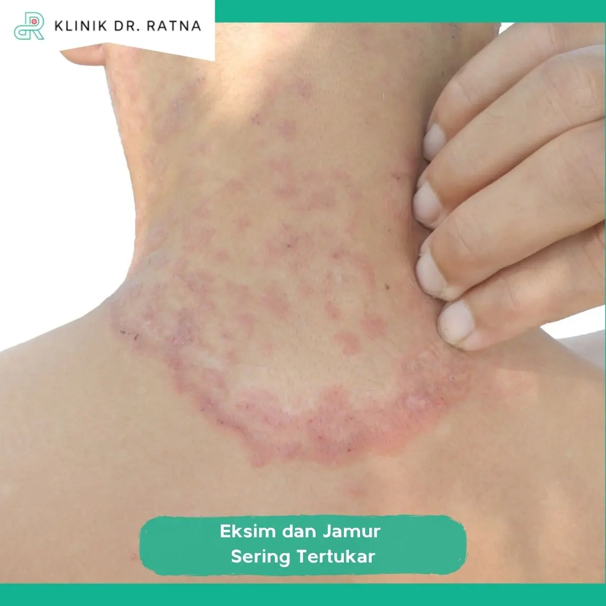 Mengapa Eksim dan Infeksi Jamur Sering Tertukar?