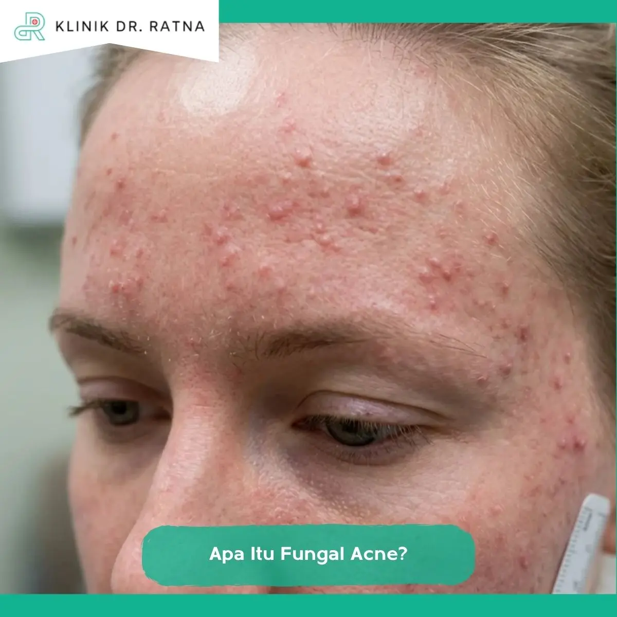 Apa Itu Fungal Acne?