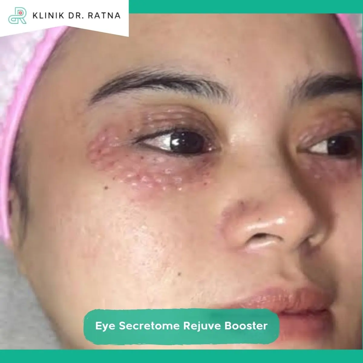 Berapa Lama Hasil Eye Booster Mulai Terlihat dan Berapa Kali Treatment Dibutuhkan?