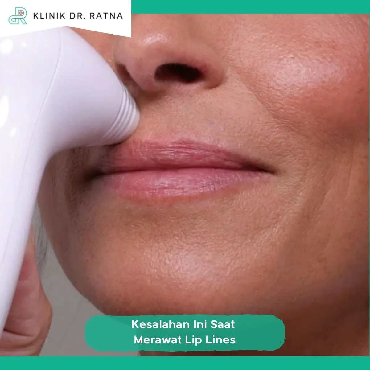 2. Filler Bukan Selalu Solusi untuk Garis Bibir