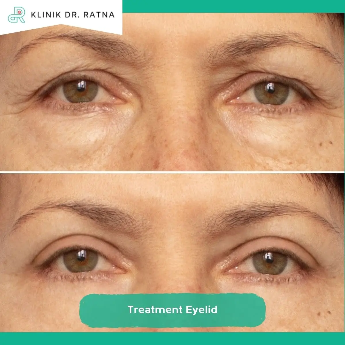 Treatment Eyelid untuk Mengurangi Lemak di Area Kelopak Mata
