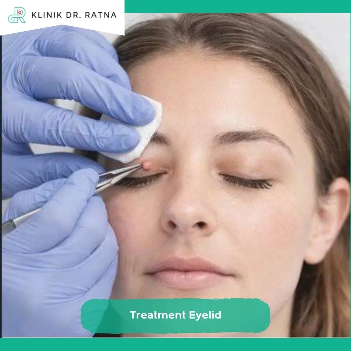 Proses Treatment Eyelid dan Masa Recovery