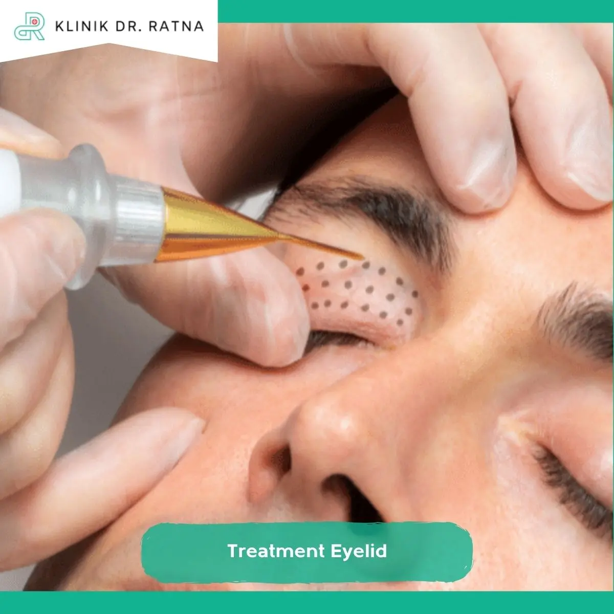 Treatment Eyelid untuk Mengurangi Lemak di Area Kelopak Mata